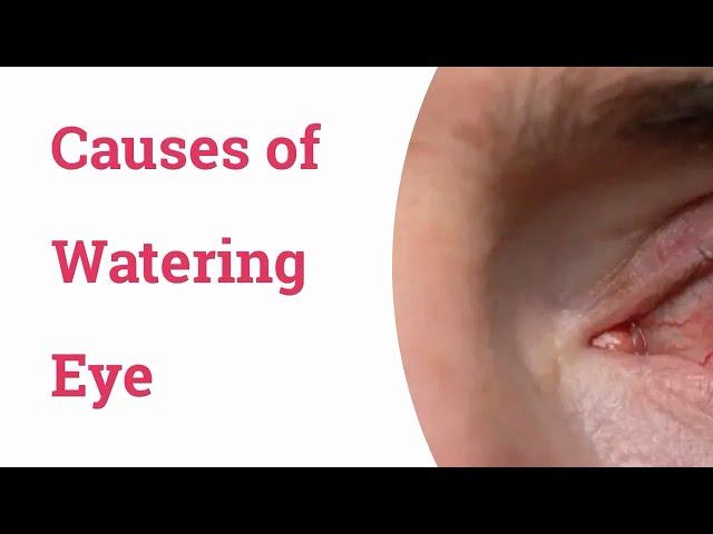 Causes of Watering Eyes - Optometry Club