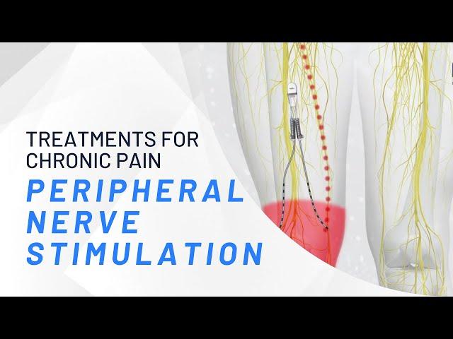 Peripheral Nerve Stimulation - What You Need To Know