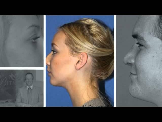 Rhinoplasty in Utah - Bitner Facial Plastic Surgery