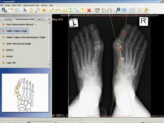 TraumaCad - Hallux Valgus Angle