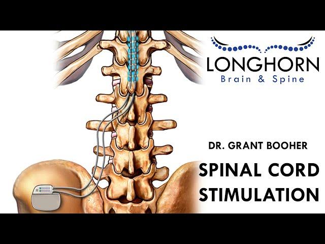 Longhorn Brain and Spine - Spinal Cord Stimulation