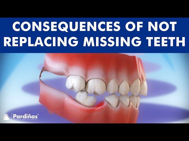 Consequences of not replacing missing teeth ©