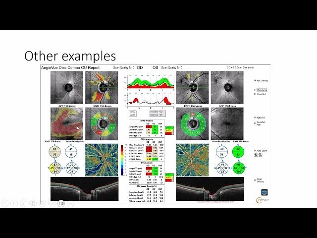 Unlocking the Potential of OCT-Angiography in Glaucoma with Dr. Mike Cymbor