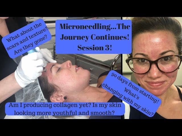 Microneedling Procedure For Acne Scars & Textured Skin: Part Three