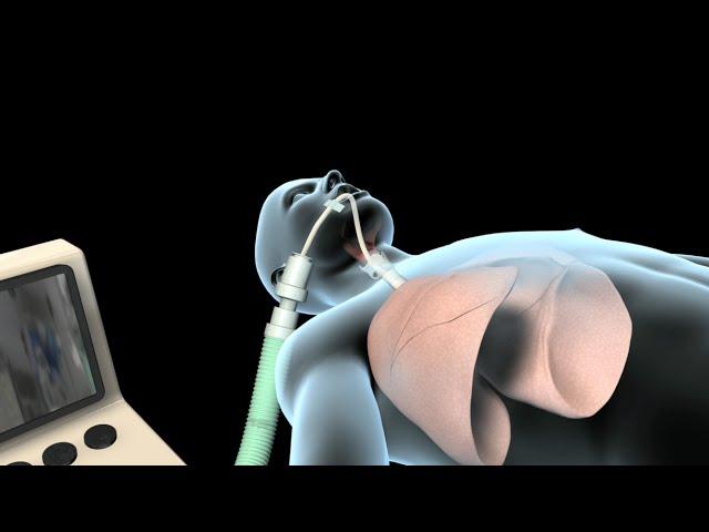 Intubation & Mechanical Ventilation (Ventilator)