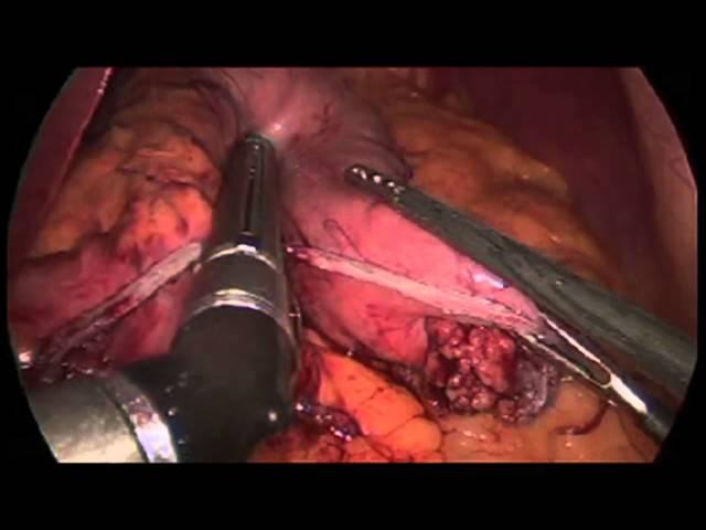 Sleeve Gastrectomy Demonstration: Memorial Weight-Loss Surgery Program