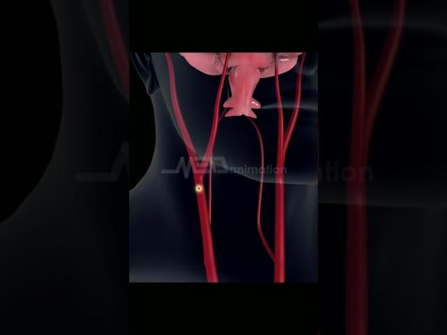 Stroke #3danimation #brain #stroke #health