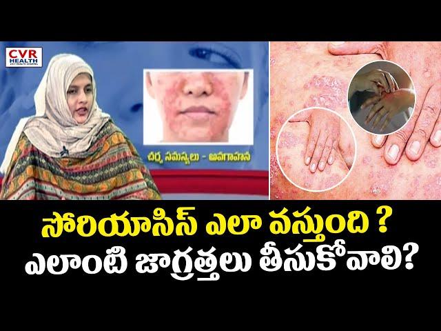 సోరియాసిస్ ఎలా వస్తుంది ? ఎలాంటి జాగ్రత్తలు తీసుకోవాలి? | The Precautions Take Psoriasis| CVR Health