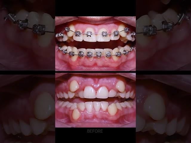 Braces process