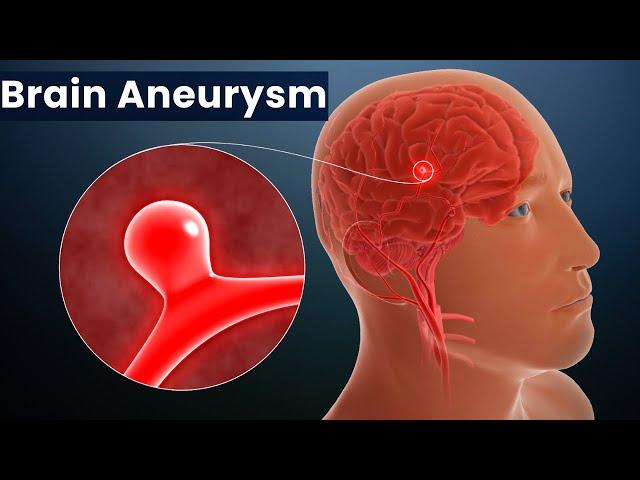 Brain Aneurysm, Causes, Signs and Symptoms, Diagnosis and Treatment.