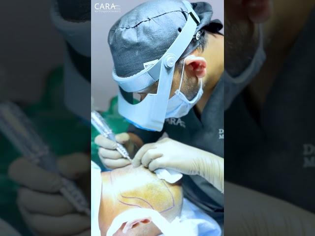 Viral Hair Transplant Surgery at Cara Clinic