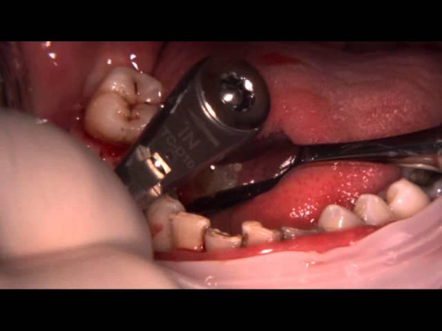 C-TECH EL Implant Live Protocol