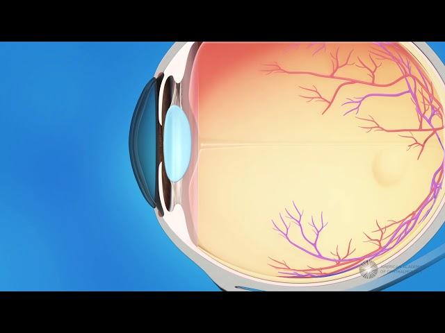 What is glaucoma?