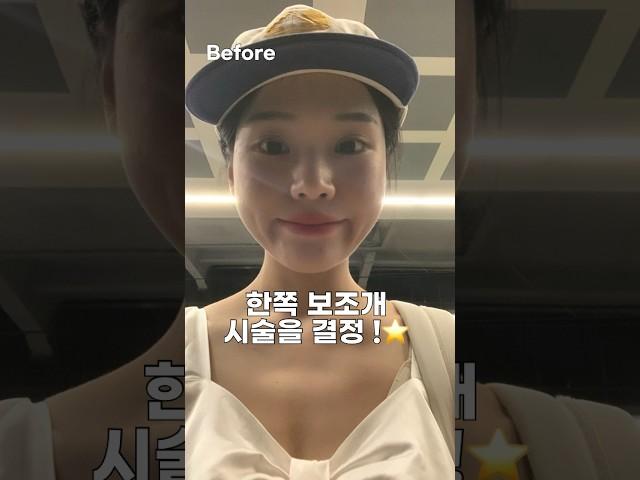 보조개 시술 후기 #보조개 #쁘띠시술
