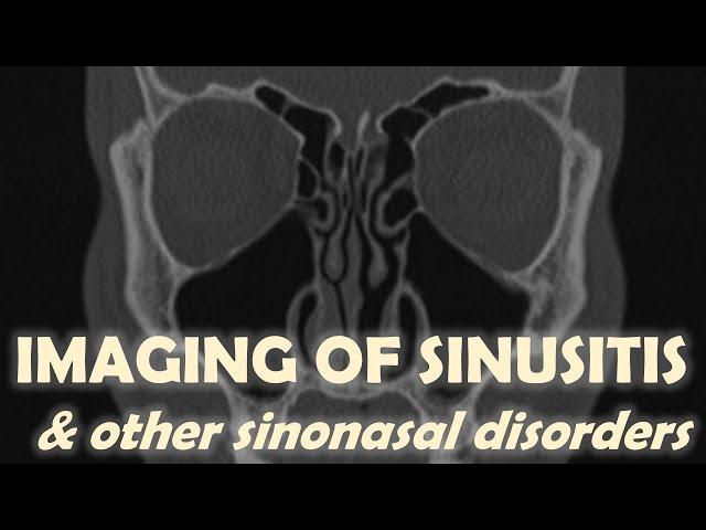 Imaging Findings in Acute & Chronic Sinusitis (including Polyposis & Sinonasal Tumors)