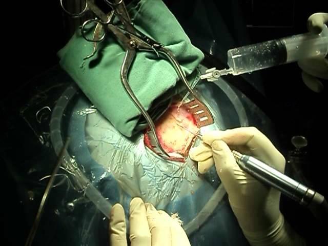 Harmless Karam Chand method of craniotomy