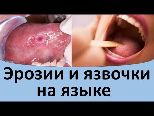 Эрозии и язвочки на языке