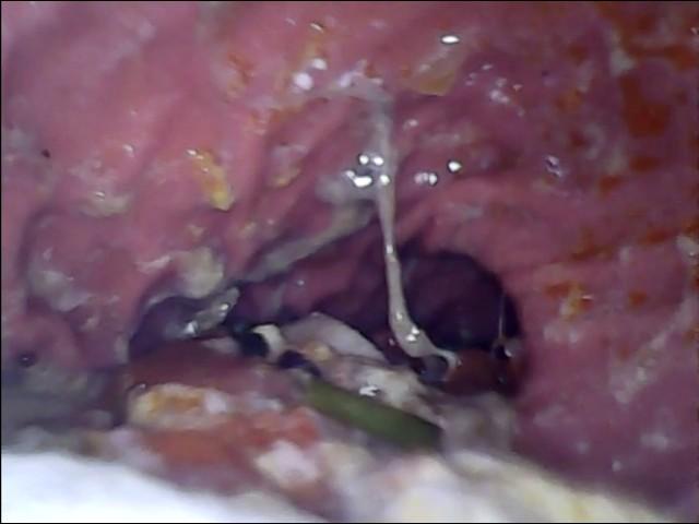 Digesting Sausage Chunks | Stomach Sphincter Churning | Endo Cam