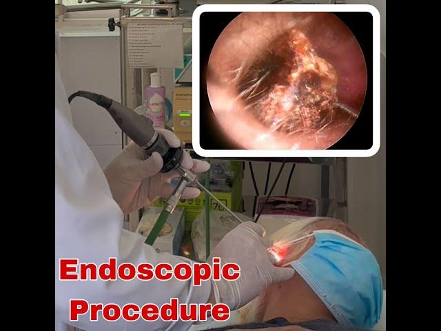 Endoscopic earwax removal Procedure | Doctor Anh