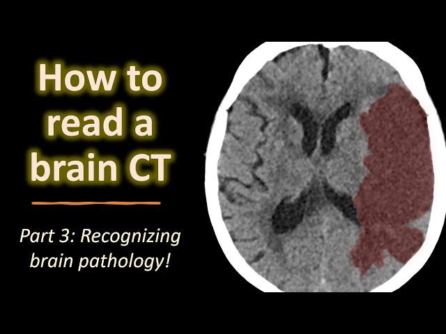 How to read a brain CT (part 3): acute brain pathology