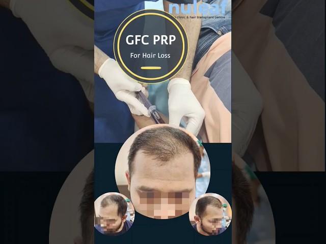 GFC using Plasma for treatment hair loss | Hair Growth after 4 sessions | Androgenetic Alopecia