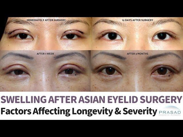 Temporary Swelling after Asian Double Eyelid Surgery - Factors that Affect Severity Healing Time