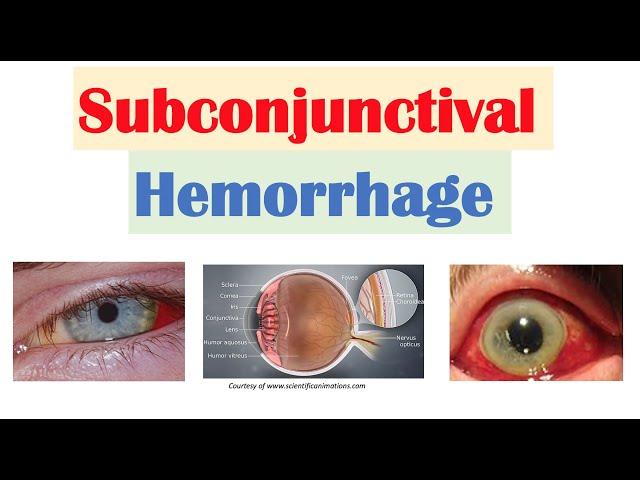 Subconjunctival Hemorrhage (Blood in Eye) | Causes, Signs & Symptoms, Diagnosis, Treatment