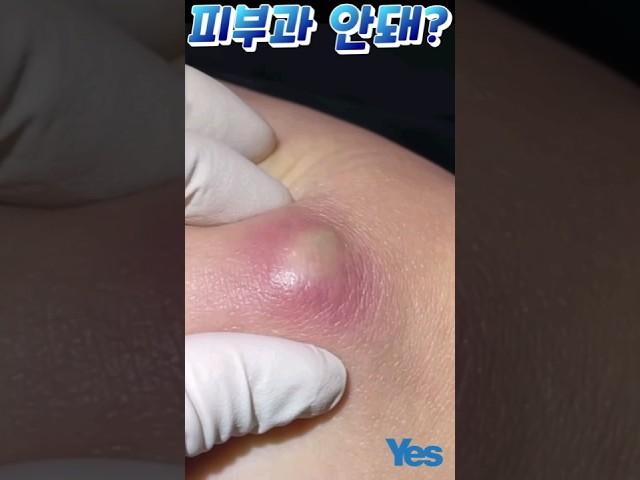 피부과에서 피지낭종 수술이 안된대요 part1