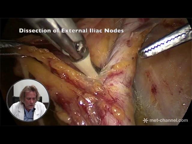 Laparoscopic systematic pelvic lymphadenectomy by Dr. Marcello Ceccaroni, MD., Ph.D