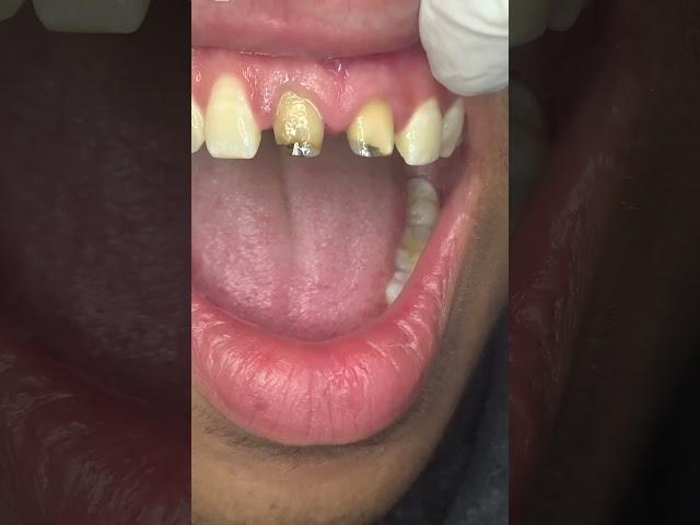 Porcelain crowns beauty #umairtoothfairy #dentist #satisfying #umairazeem #shorts @Umairazeem8553