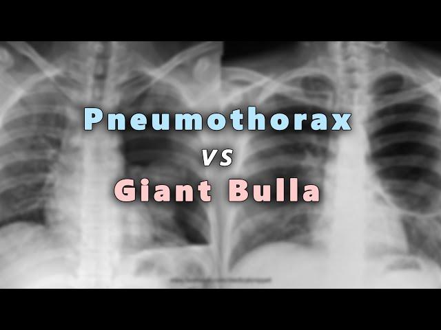 Pneumothorax  vs Giant Bulla in Chest X Ray (Part 6)