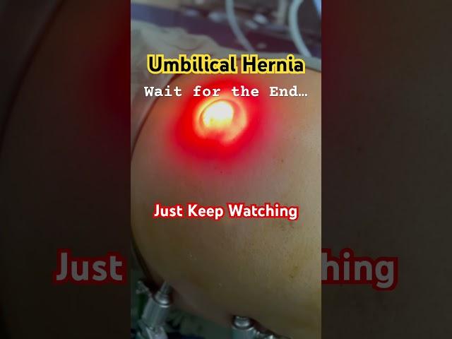  Watch Till the End: Live Hernia Surgery from Inside! | Best Hernia Surgeon Explains #shorts