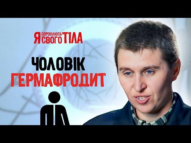 Гермафродит мріє стати повноцінним чоловіком – Я соромлюсь свого тіла | МЕДИЦИНА