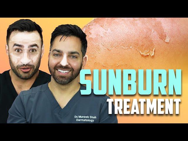 SUNBURN - How To Treat a Sunburn like a Dermatologist