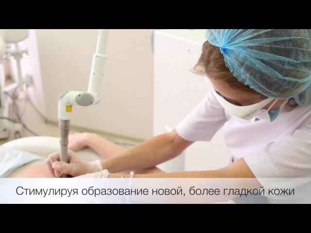 Лазерное лечение растяжек в NEO-Clinic