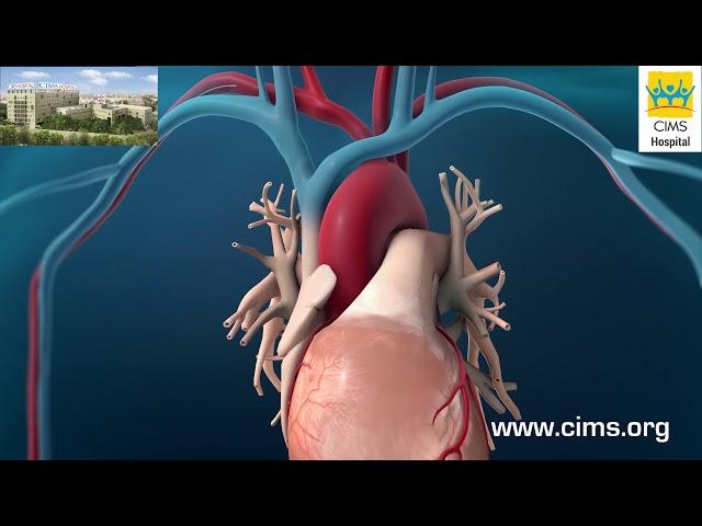 Coronary Artery Angioplasty Radial Access - CIMS Hospital