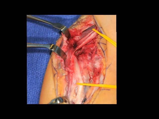 Split Median Nerve Graft -Case Report, Scott Kozin, MD and Dan Zlotolow, MD