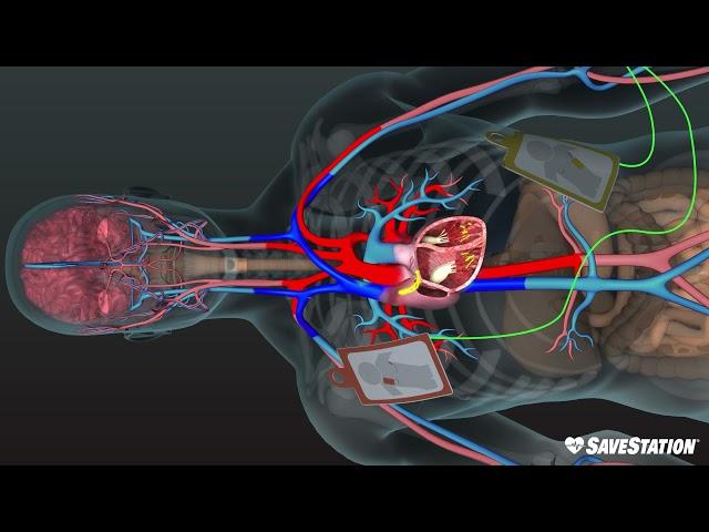 AED in Action | A 3D look inside the body