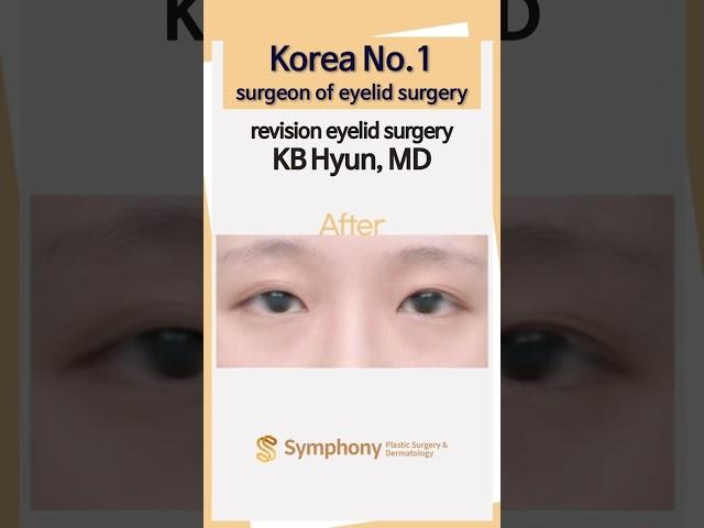 Korean eyelid revision surgery before and after pictures, Korean No.1 surgeon's techique!! #shorts