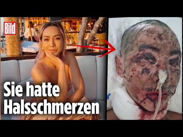 Thailändisches Influencer-Model durch Medikament entstellt