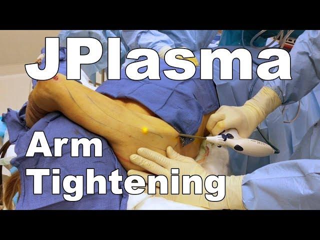 Renuvion (JPlasma) - Subdermal Arm Tightening - Dr. Paul Ruff | West End Plastic Surgery