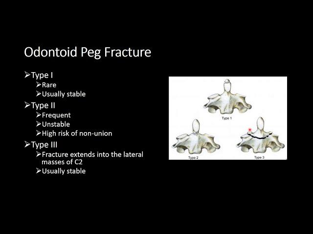 Cervical Spine  Trauma Part 2