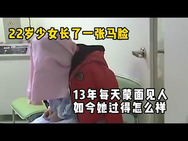 22岁少女长了一张马脸，13年每天蒙面见人，如今她过得怎么样？