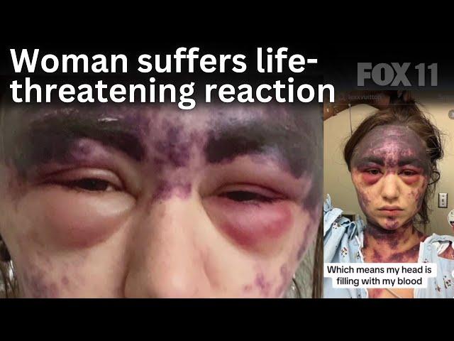 CA woman, 23, suffers severe reaction after hospital allegedly requires vaccines for treatment