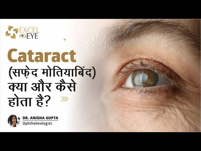 Cataract (सफ़ेद मोतियाबिंद) क्या और कैसे होता है? Dr Anisha Gupta - Eye Specialist in Delhi,Excel Eye