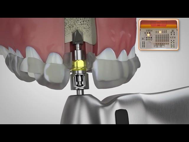 BioHorizons Pro Surgical Kit Drilling Sequence [Keyless Guided Surgery]