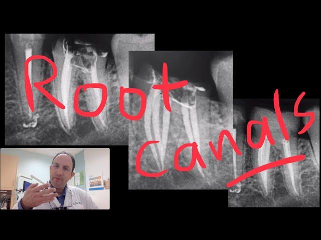 Root Canals and Retreats of Root Canals #18