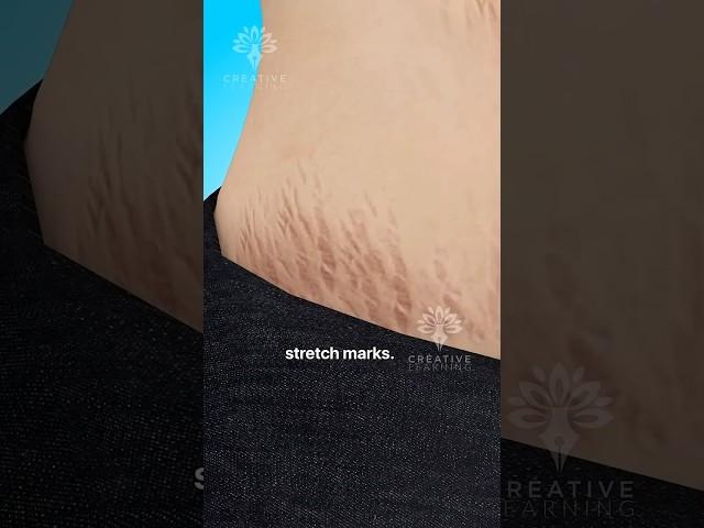 Why Do Stretch Marks Really Happen  #shorts #viralvideo - Creativelearning3d