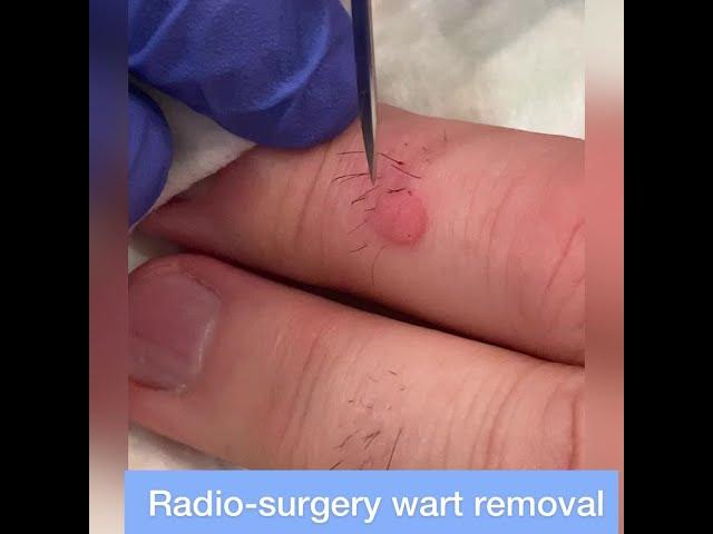 Wart Removal by Radiosurgery - Quick & Thorough Removal of Stubborn Finger Warts!