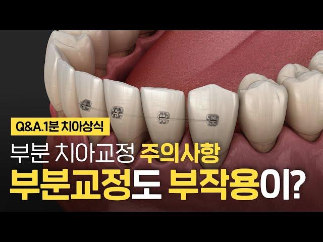 부분교정 부작용이 있다?! 전체교정 부분 치아교정 부작용은 과연? ⏰1분 치아상식!!